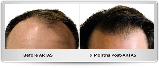 Hair Transplant Portland – ARTAS Advanced FUE Hair Restoration Portland  Oregon